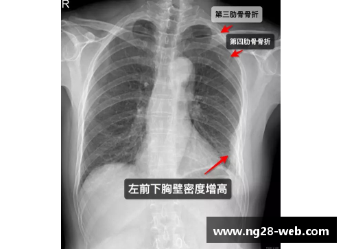 球员肋骨骨折：运动场上的隐形伤痛